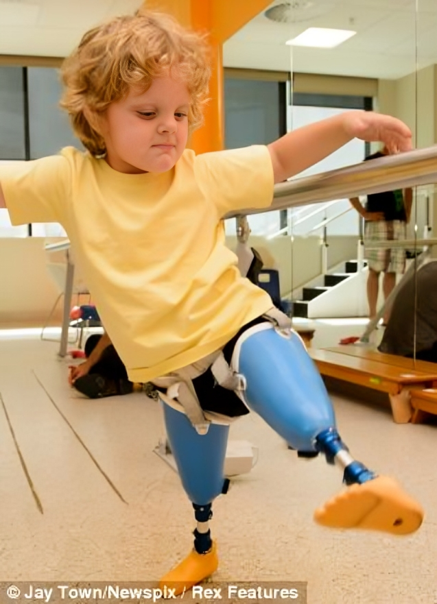 طرف صناعي للأطفال